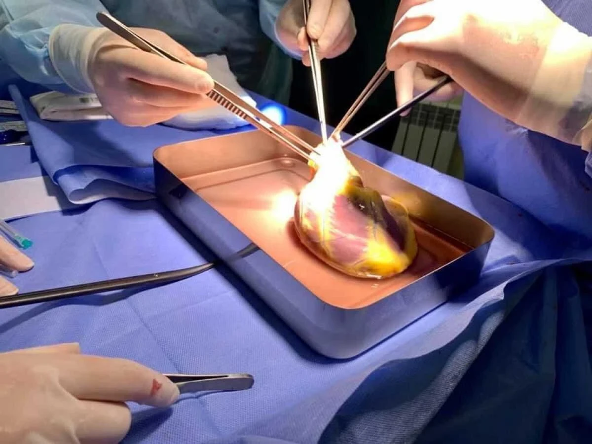 Latvijā veikta 50. sirds transplantācijas operācija